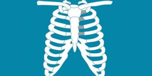 Costocondritis_fisioterapia