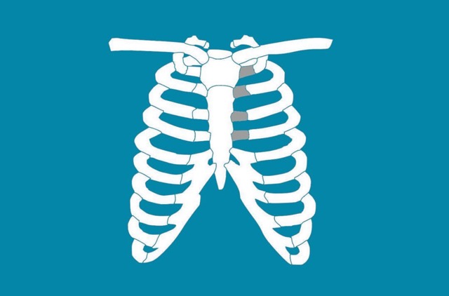 Costocondritis_fisioterapia